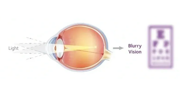 Eye with Myopia
