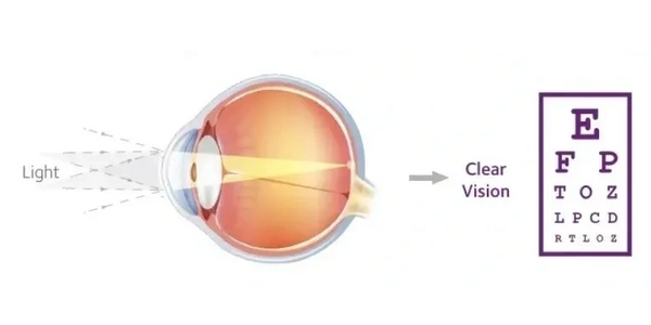 Eye without Myopia