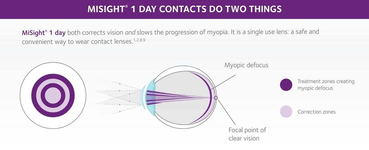 MiSight 1 day contacts both corrects vision and slows the progression of myopia.