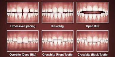 crowding
open bite 
tongue thrusting
crooked teeth
narrow palate
receded jaw
cavities