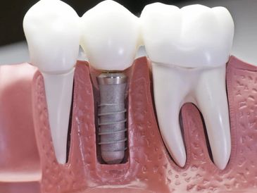 Richmond Dental Spa Implant dentistry