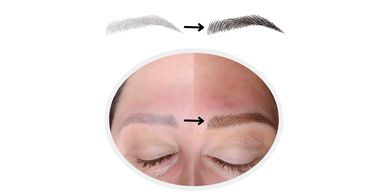 brow correction