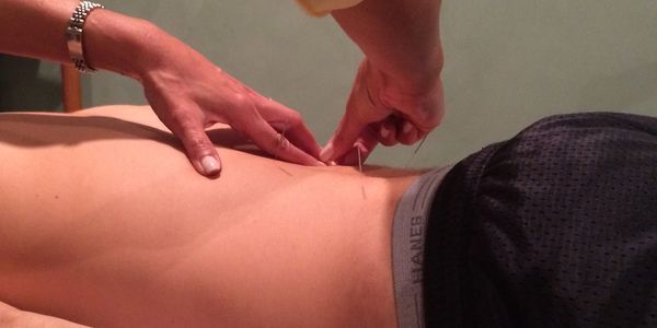 Acupuncture on lower back