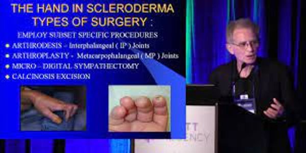 Dr Melone discusses scleroderma surgery