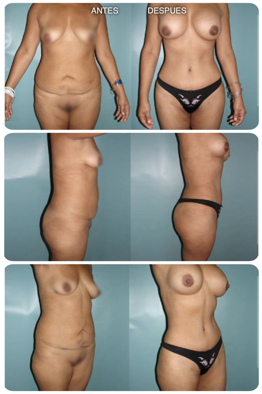 Abdominoplastioa lipoescultura