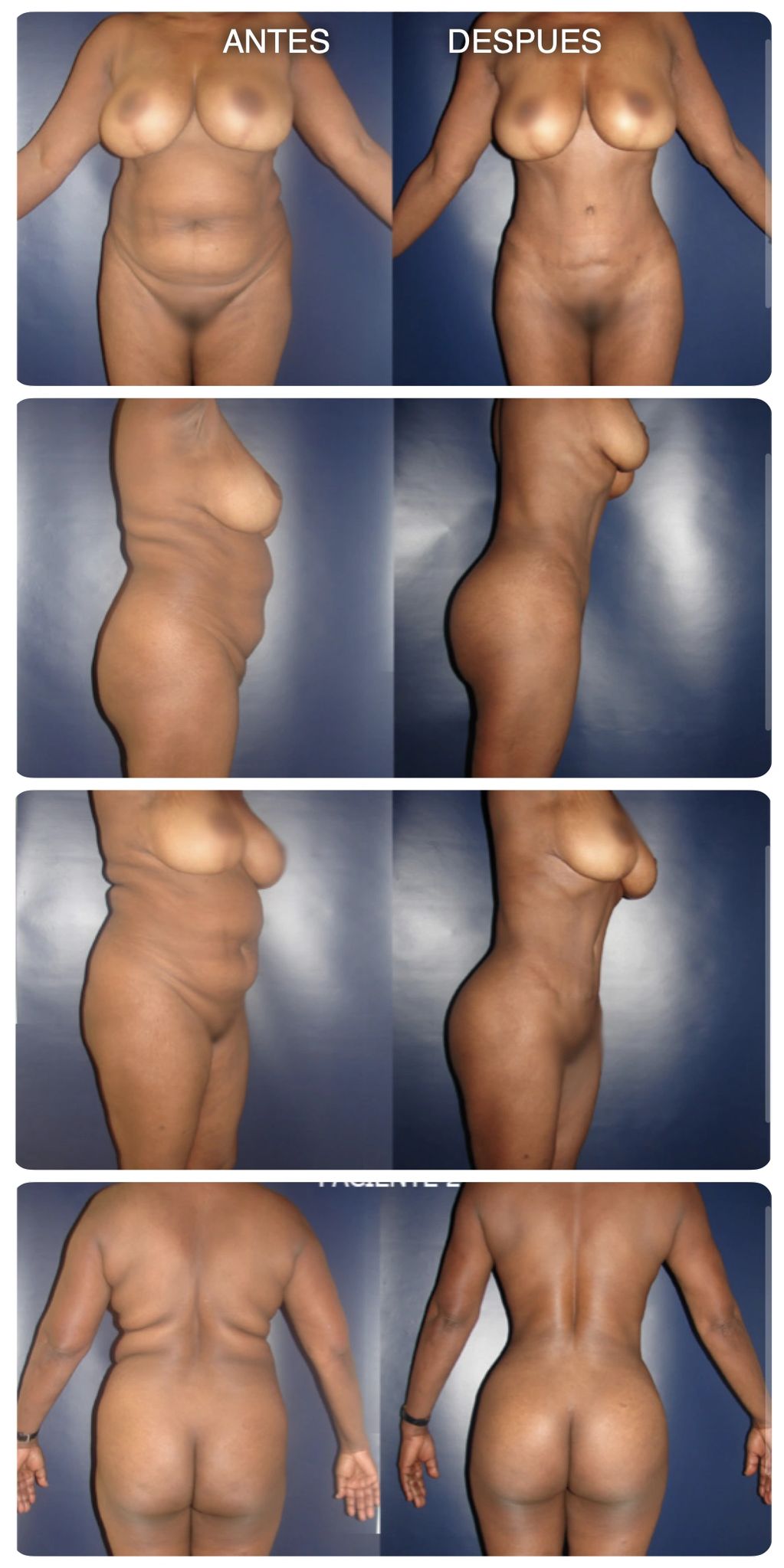 Abdominoplastia Lipotransferencia