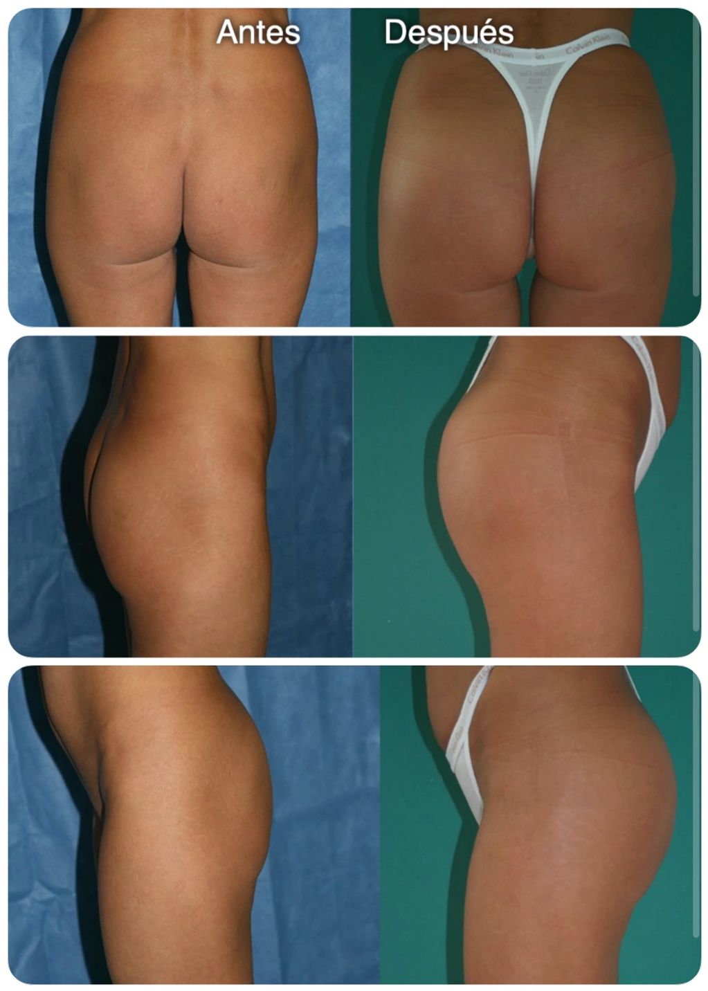 Gluteos lipotransferencia