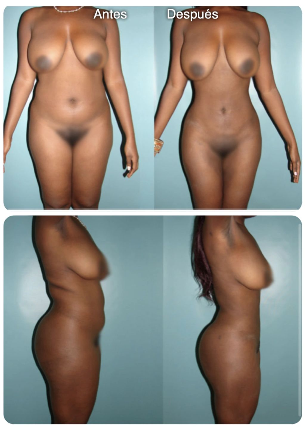 Lipoescultura Lipotransferencia