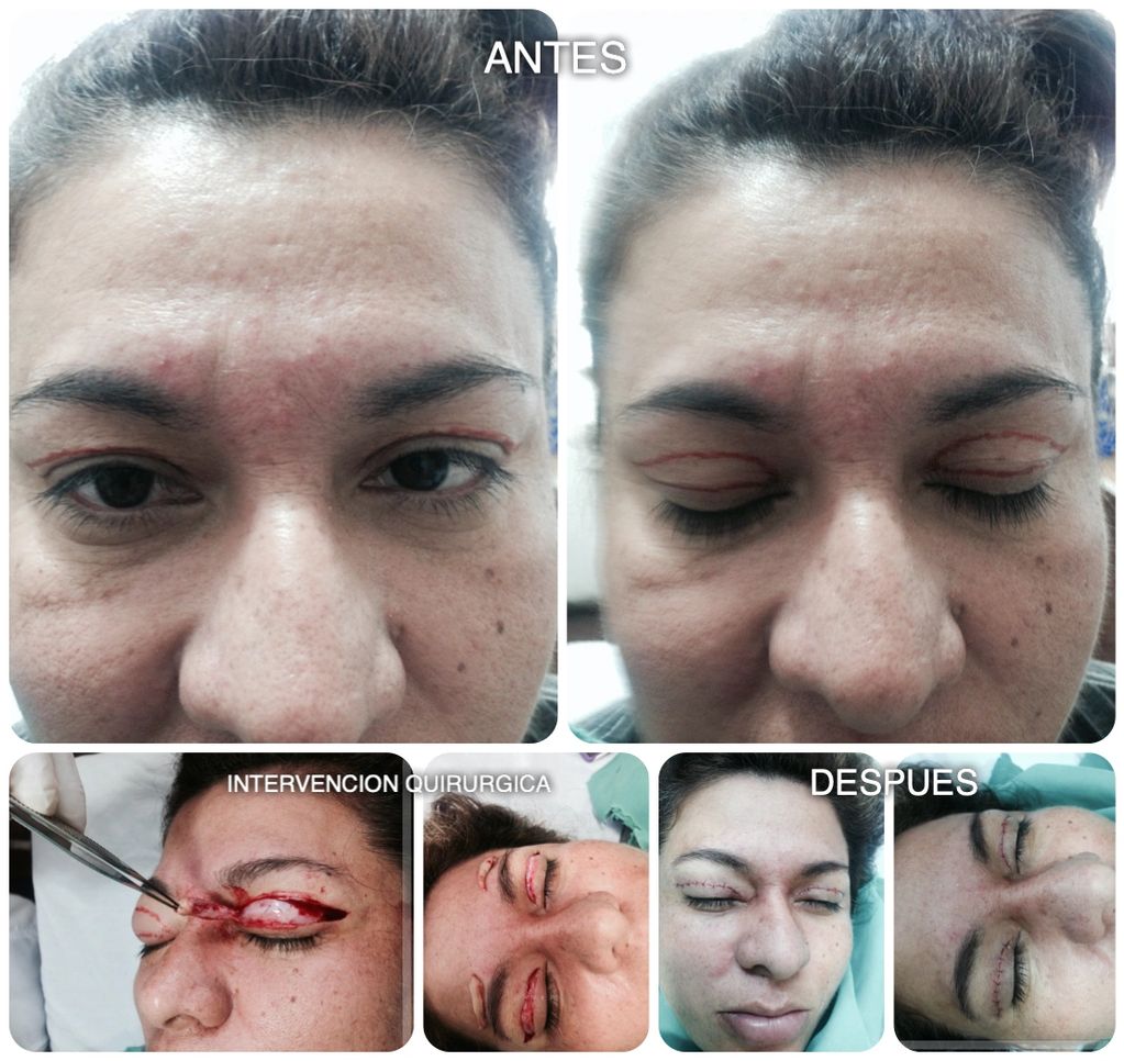 Parpados blefaroplastia