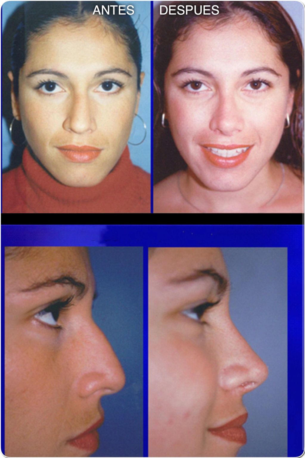 Rinoplastia