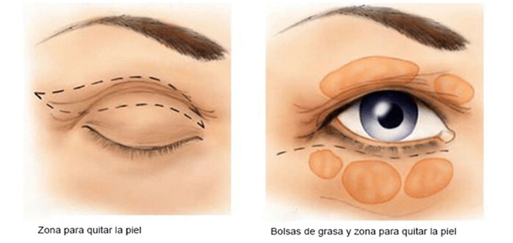 Parpados blefaroplastia
