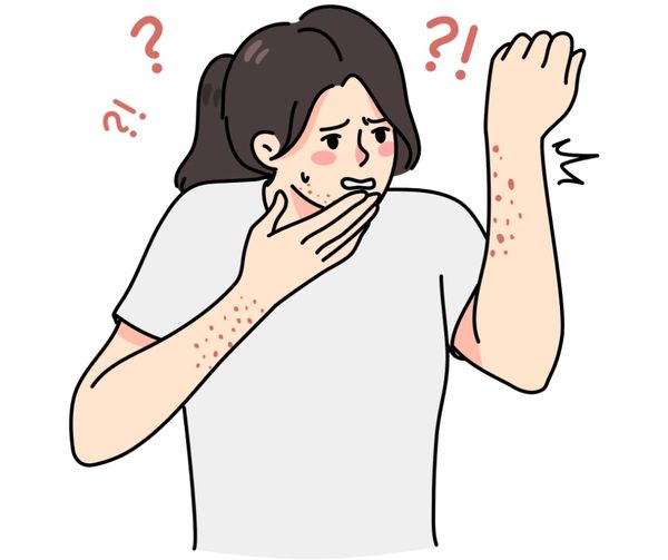 Dermatitis
