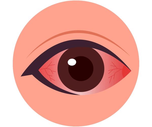 Pink eye