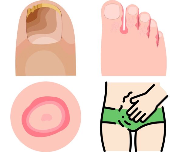 Fungal skin infections