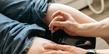 Dry Needling being performed by Tim the podiatrist