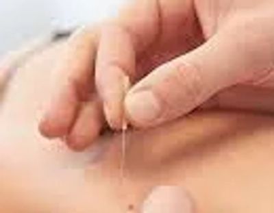 Dry needling upper trapezius muscle
Credit: Sandy Sports Massage