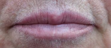 Antes de Micropigmentación de Labios