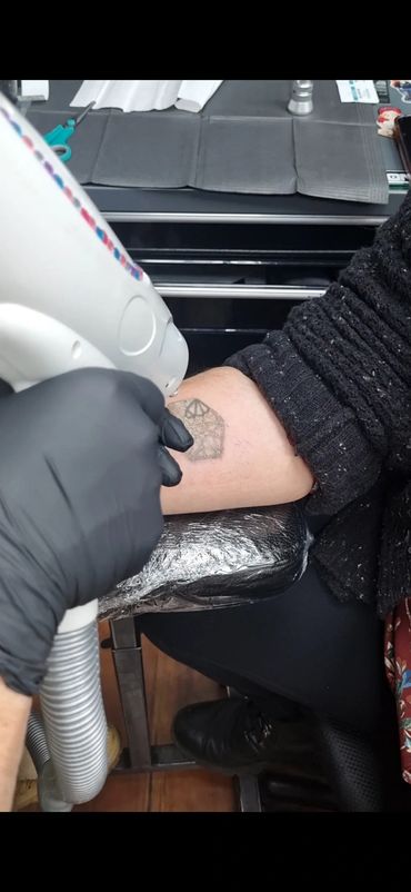 Sesion de Borrado de tatuaje con láser Nd Yag Q Switched en proceso
