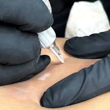 Sesión de Micropigmentación, Camuflaje de Estrías.