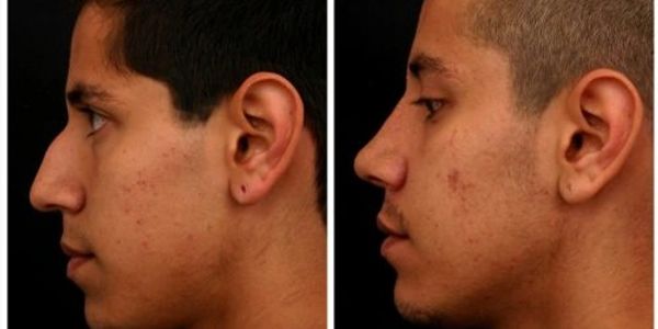 Cirguia plastica guadalajara, cirugia masculina guadalajara, cirugia plastica para hombres gdl