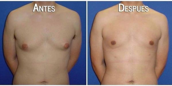 Cirguia plastica guadalajara, cirugia masculina guadalajara, cirugia plastica para hombres gdl