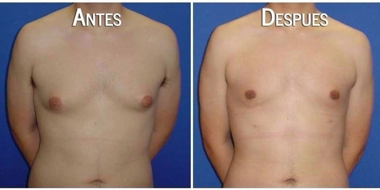Cirguia plastica guadalajara, cirugia masculina guadalajara, cirugia plastica para hombres gdl