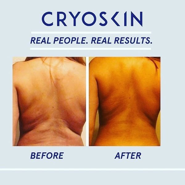Cryoskin. Real People, Real Results