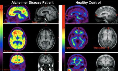 Alzheimer Disease