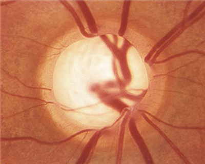 Glaucomatous Optic Nerve