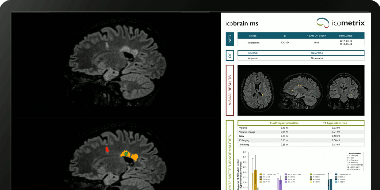 icobrain ms report of an MRI image of a person with MS