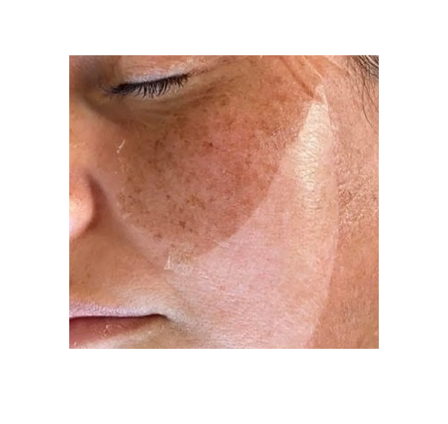 Skin renewal peel treatment skin lifted, pigmentation lifted, freakles, brighter, rejuvenated skin