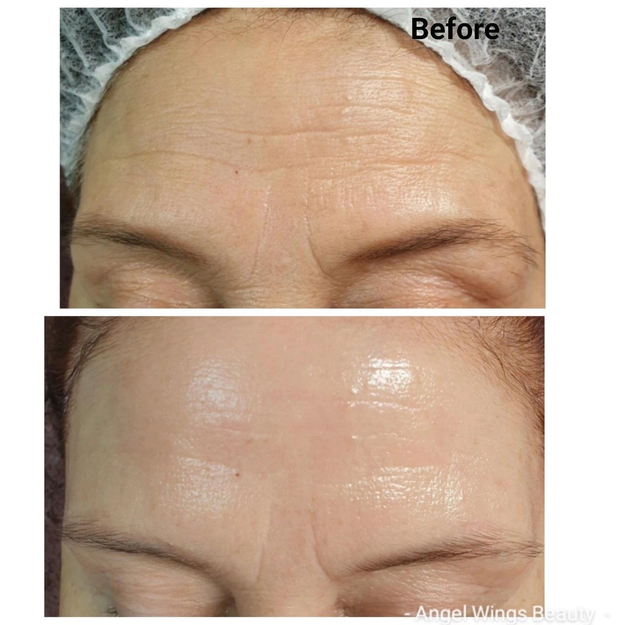 Sculplla filler treatment, filler results, plump lines and wrinkles, before and after photo. PLLA 