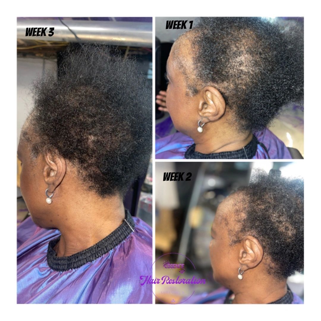 This specific client has Tractional Alopecia & CCA Alopecia, which is also known as Scarring Alopeci