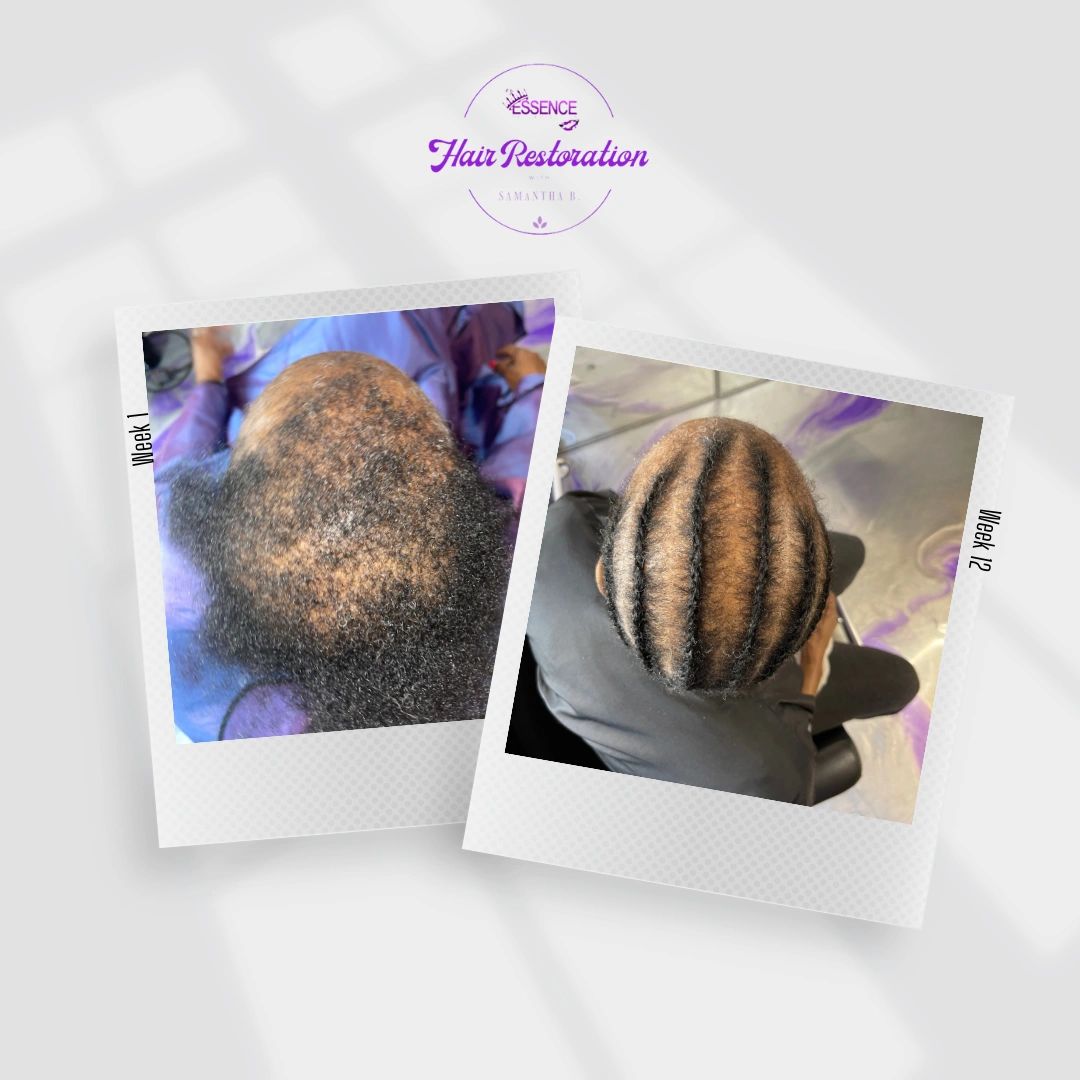 tHis specific client was suffering with CCCA alopecia and Tractional alopecia. 