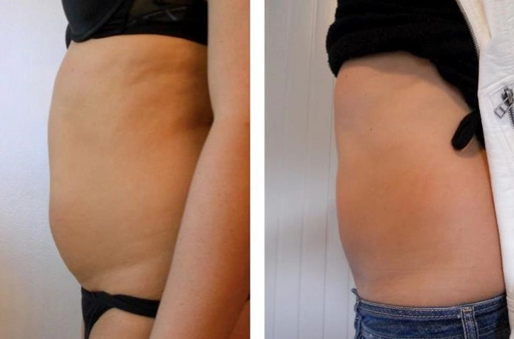 Fat dissolving lowestoft, flat tummy, how to get a flat tummy, double chin reduction