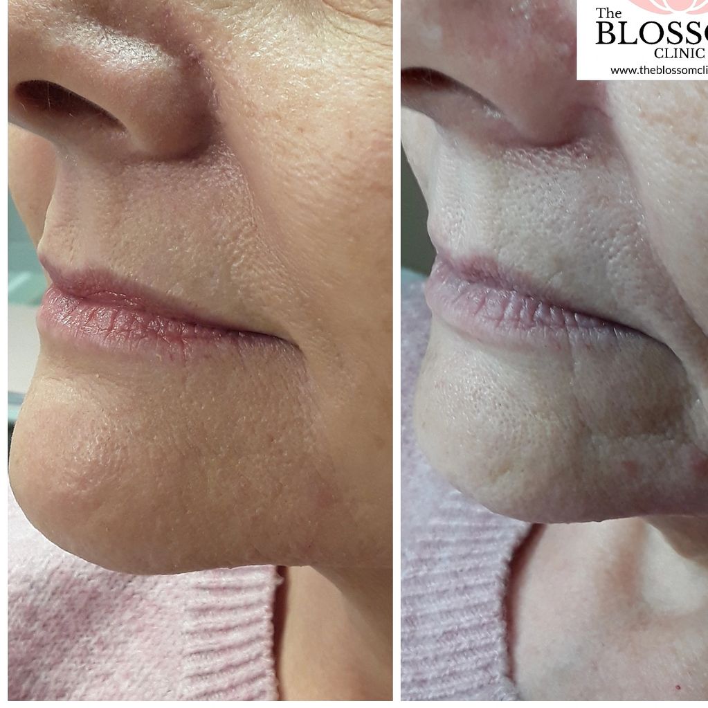 Double chin reduction, non surgical fat reduction, get rid of double chin