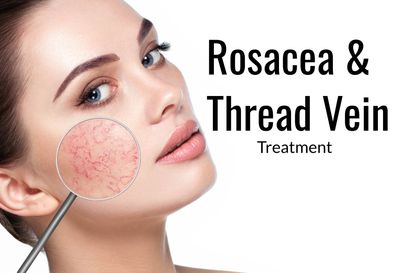 Thread Vein removal beccles, rosacea treatment