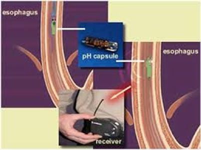 esophageal ph testing
non cardiac chest pain
bravo capsule
lump in throat
regurgitation