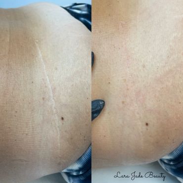 Tummy tuck scar immediately after first session by Lara Jade Beauty in Toronto