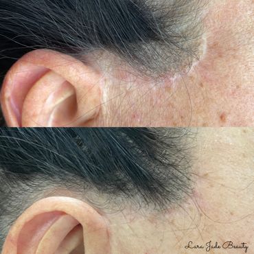 Facelift scar one day after one session of tattoo scar camouflage by Lara Jade Beauty in Toronto