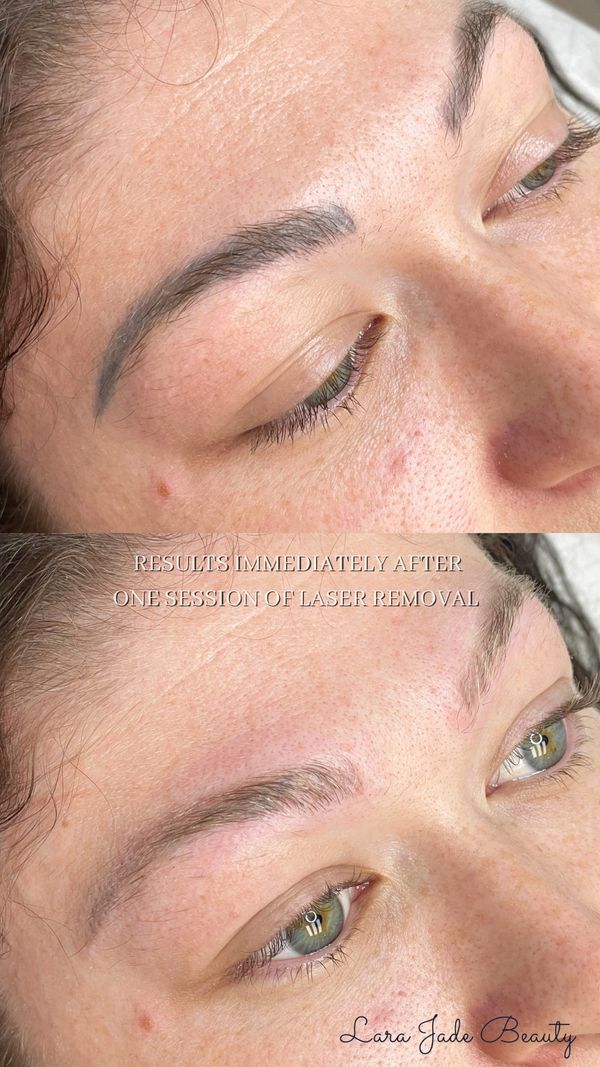 Before and after Phi laser tattoo removal by Lara Jade Beauty in Toronto