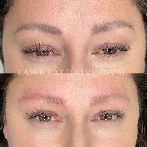 LASER TATTOO REMOVAL After Before