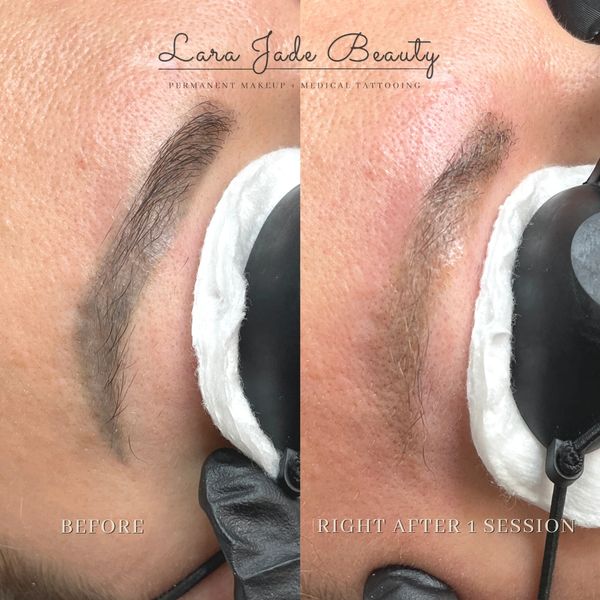 Before and after Phi laser tattoo removal by Lara Jade Beauty in Toronto