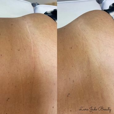 Tummy tuck scar immediately after first session of tattoo scar camouflage by Lara Jade Beauty