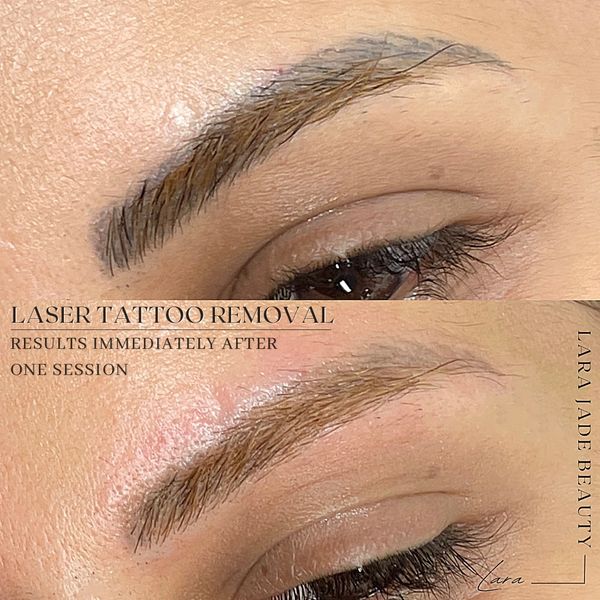 Before and after Phi laser tattoo removal by Lara Jade Beauty in Toronto