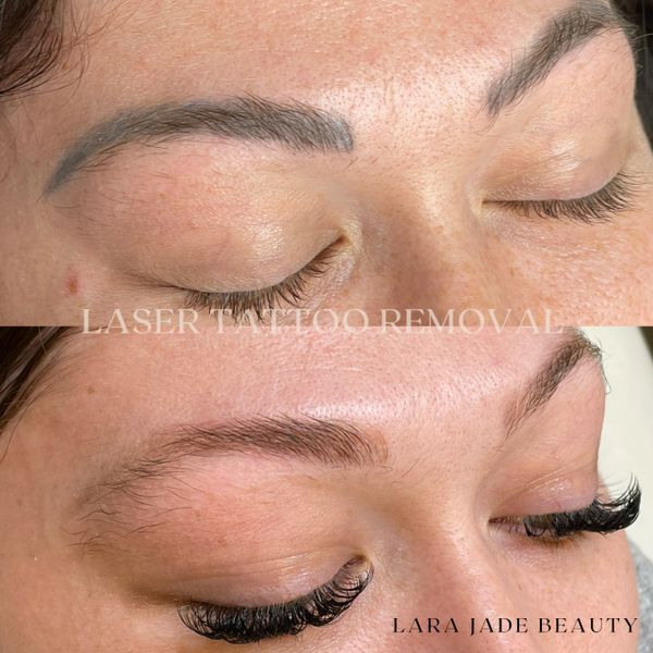 LASER TATTOO REMOVAL After before
