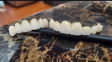 Two sets of dental veneers resting on a black pen on a marble surface.