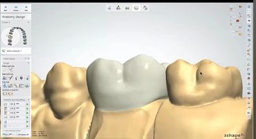 3D dental crown design software interface showing a molar crown.