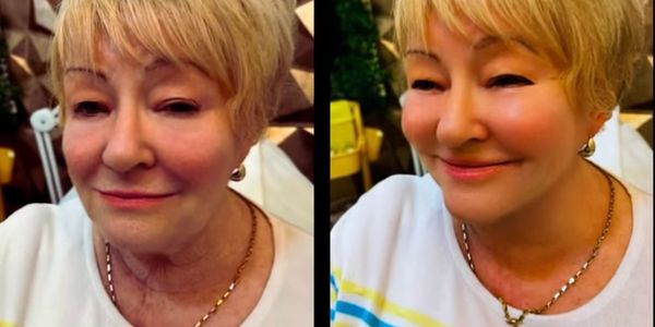 Morpheus8 
Advanced Skin Rejuvenation
Before & after 1 treatment 
Before & After Photos