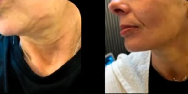 7D High Intensity Focused Ultrasound (HIFU)
Before & After images